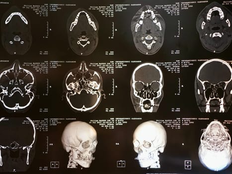 MRI of the human brain of a patient with multiple sclerosis of the initial stage. Close-up X-ray vertical