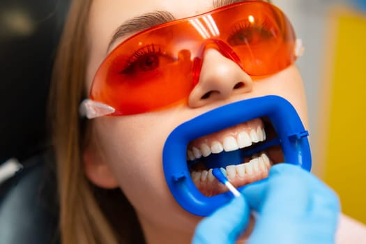 Teeth whitening procedure for young beautiful woman in orange protective goggles.