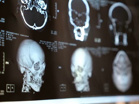 MRI of the human brain of a patient with multiple sclerosis of the initial stage. Close-up X-ray