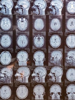 MRI of the human brain of a patient with multiple sclerosis of the initial stage. Close-up X-ray vertical