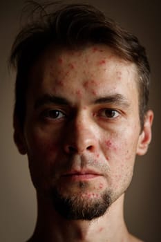 Red rash on the face of an adult male infected with chickenpox.