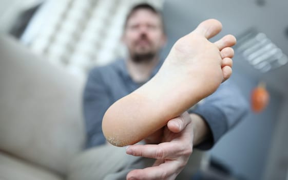 Close-up of man applying moisturizing lotion on problem areas on skin. Barefoot man with unhealthy and unattractive heel. Uncomfortable shoes and damaged foot
