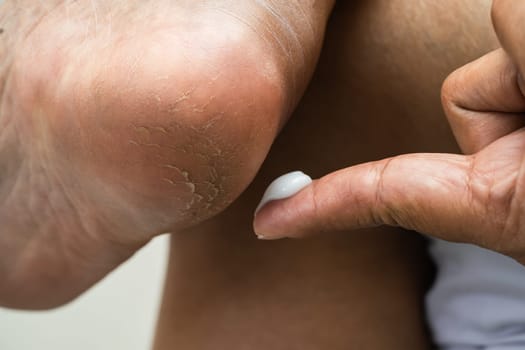 Woman care feet with cracked and dry heel skin cream at home.