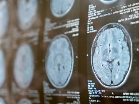 MRI of the human brain of a patient with multiple sclerosis of the initial stage. Close-up X-ray