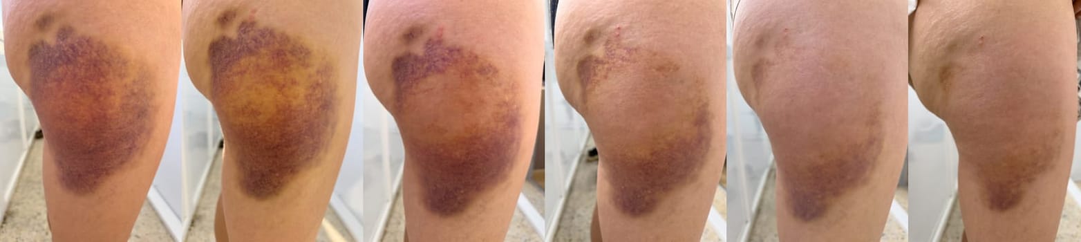 Photos document the healing stages of a skin bruise, displaying changes over time.