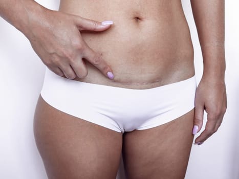 Woman pointing to c section scar on abdomen in underwear for postpartum awareness.