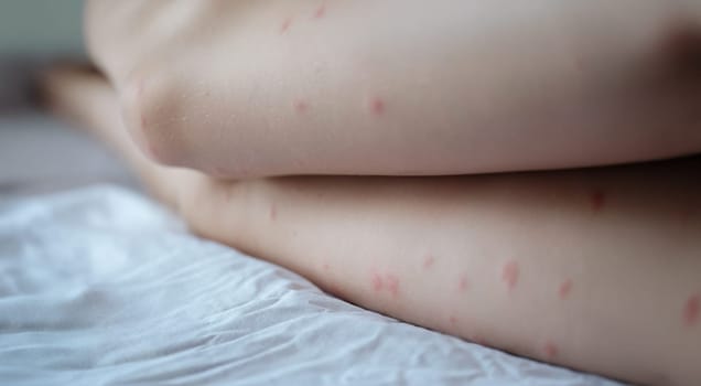 Red rash on the white skin of female legs, close-up. Allergy urticaria, dermatological disease, examination, diagnosis