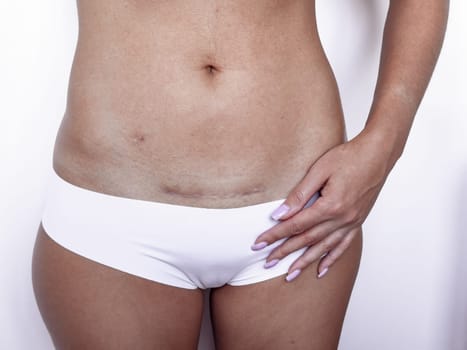 C section recovery. Woman showing cesarean scar and healing postpartum body.
