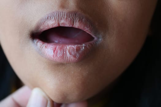 close up of dry lip of a child ,