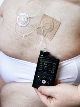 Medical device for diabetes management with insulin pump on patients abdomen.