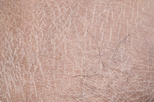 Closeup view of dry human skin