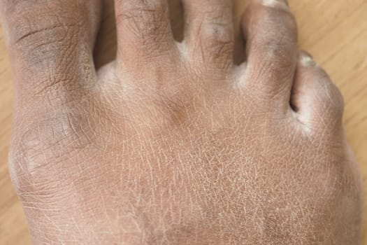 Closeup view of dry human skin