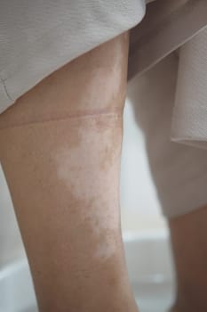 feet with vitiligo skin condition