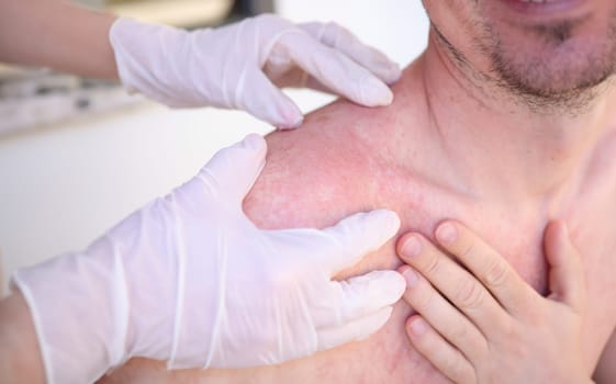 Doctor in gloves conducts initial examination of man with sunburn on skin of his shoulders and back. First aid for sunburn in adults