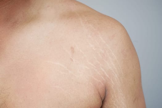 Close-Up of Stretch Marks on Human Skin for Medical and Cosmetic Purposes.