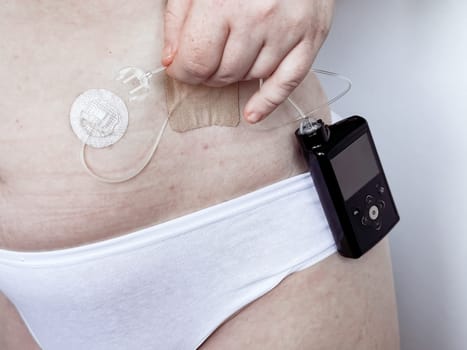 Close up of womans glucose monitoring and insulin pump device.