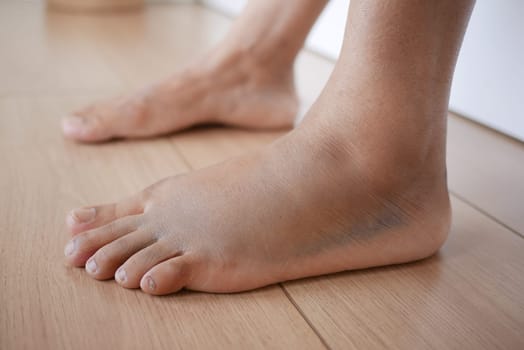 close up of women feet with swelling .