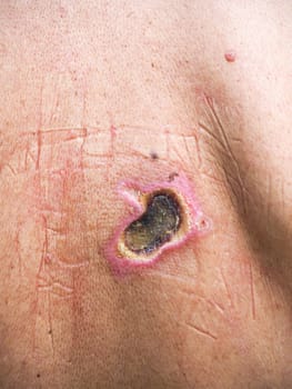 Electrical burn showing entry and exit wounds on the back of a caucasian man, highlighting the damage caused by electricity passing through the body