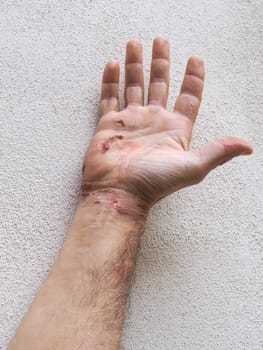 Adult man displays electrical burns entry and exit wounds on his hand and wrist, highlighting the potential dangers of electricity and the importance of safety precautions