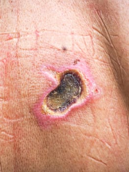 Electric shock leaving an entry and exit wound on the skin of a caucasian adult man, highlighting the dangers of electricity and the importance of safety precautions