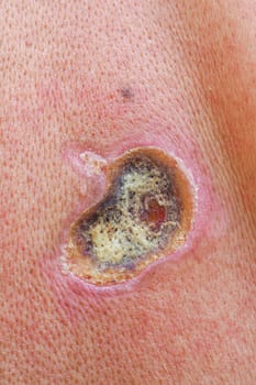 Electric current passing through body tissue causes a third-degree burn wound with skin entry and exit point, highlighting the dangers of electricity and importance of safety precautions