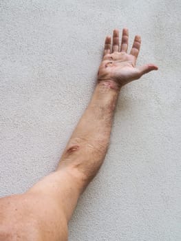Entry and exit wounds of an electrical burn are visible on a caucasian man's arm and hand, highlighting the severity and localized impact of such injuries