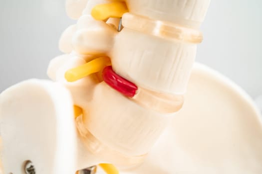 Lumbar spine displaced herniated disc fragment, spinal nerve and bone. Model for treatment medical in the orthopedic department.