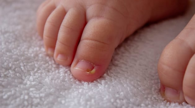 a baby, pus, a nail grew into a finger. Selective focus.