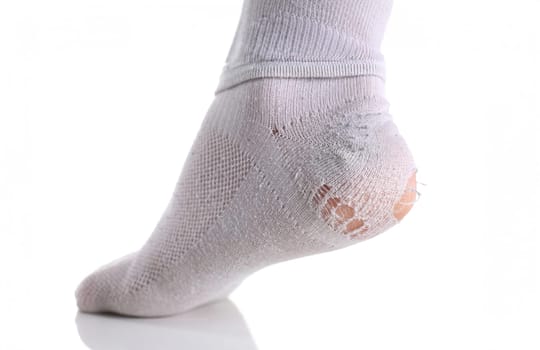 Ripped white sock on male leg isolated. A man lost everything when he took a loan from a bank on unfavorable terms. It impossible to make payments with shares of shares stripped to cracks in the heel