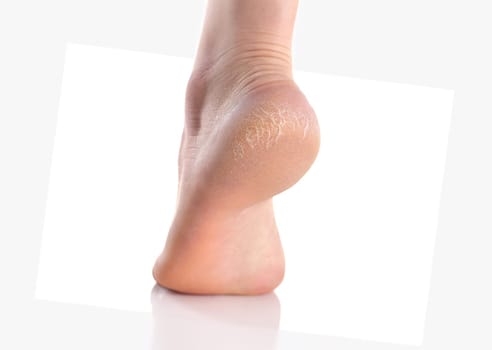 The heel of foot with bad skin is covered with cracks. The concept using medical treatment with moisturizers and also vedekure and peeling of wound healing and pain while walking swatch dermatologist