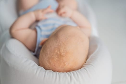 Close-up of a baby scalp showing cradle cap seborrheic dermatitis with dry, flaky patches. Common skin condition in newborns. Infant care, skincare, and health awareness concept.