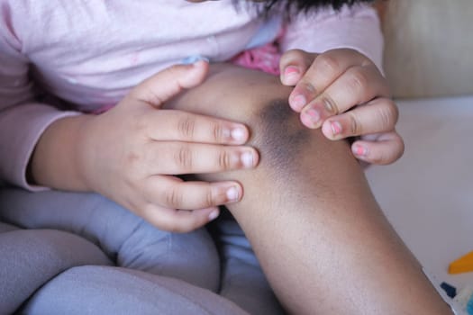 stain bruise wound on child knee