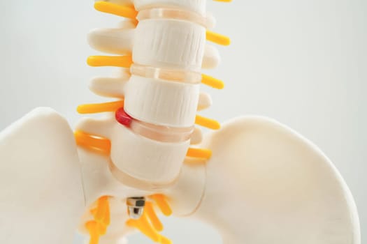 Spinal nerve and bone, Lumbar spine displaced herniated disc fragment, Model for treatment medical in the orthopedic department.