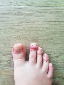 A detailed close-up of a human foot with inflamed skin and damaged toenails, resting on a wooden floor. The image highlights health concerns such as nail infection or injury.