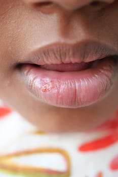 close up of dry lip of a child ,