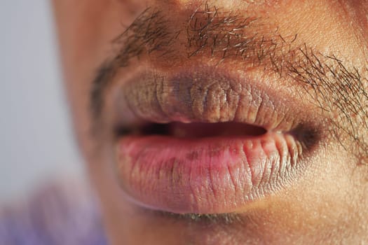 Man displays dry and cracked lips in close-up view.
