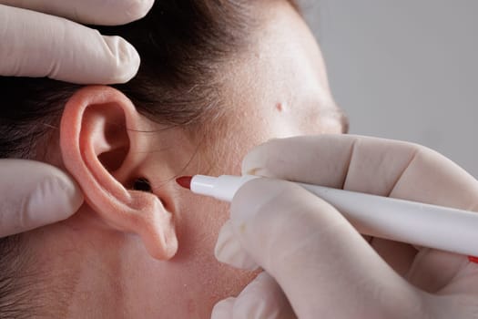 The doctor surgeon is preparing for the operation Otoplasty, Ear plastic surgery, correction of protruding ears.