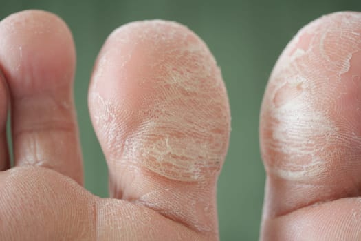 Close-up view of dry, cracked skin on fingertips showing rough patches.