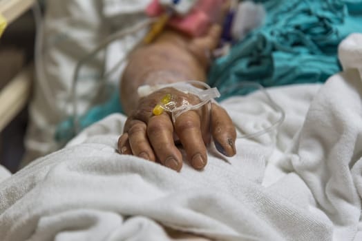 Patient in the hospital with saline intravenous on a elderly patient hand