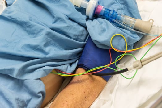Patient asian elder women 80s do tracheostomy use ventilator for breathing help on bed in the hospital.