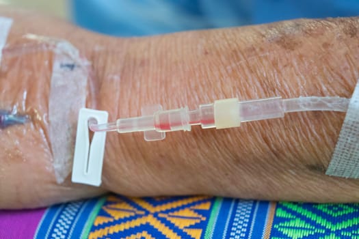 A patient in the hospital with saline intravenous, in Asian elderly man hand