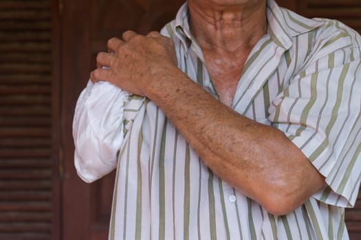 Asia elderly man have tanned skin disabled with one arm and arm prosthetic because accident