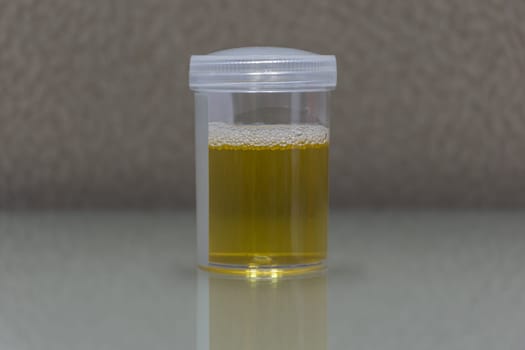 Urine sample testing in plastic bottle for examination in laboratory hospital