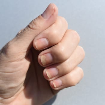 Fungal nail infection, onycholysis after shellac or gel-varnish. Isolated on white background