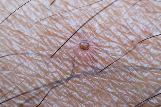 Macro of dry skin asia human with hair and dermatology