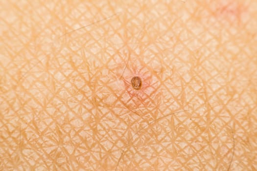 Macro of dry skin asia human with dermatology