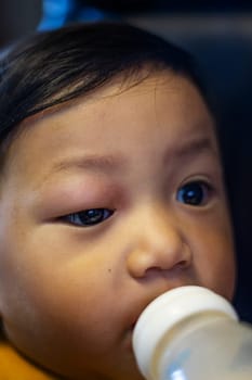 A boy was bitten by an ant on his eyelid. Allergic to insect bites.