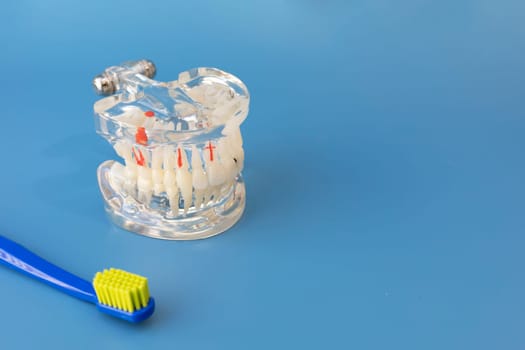 Transparent Pathological Tooth Model. Dental Education Implant Equipment And Toothbrush on Blue Background. Copy Space For text. Horizontal Mockup. Dentistry and Oral Health. High quality photo