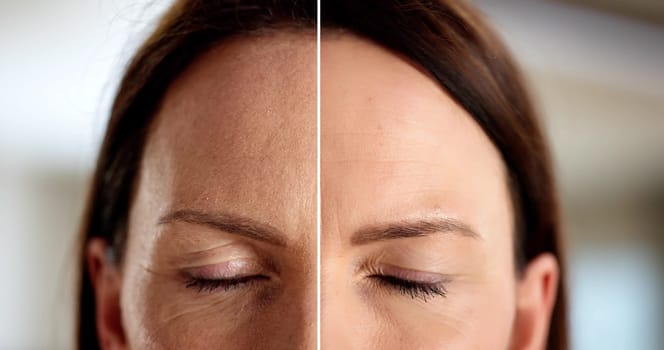 Confidence boosted with anti-aging forehead lift transformation before and after