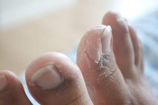 Dry skin and cracks visible on toes, reflecting neglect in foot care.